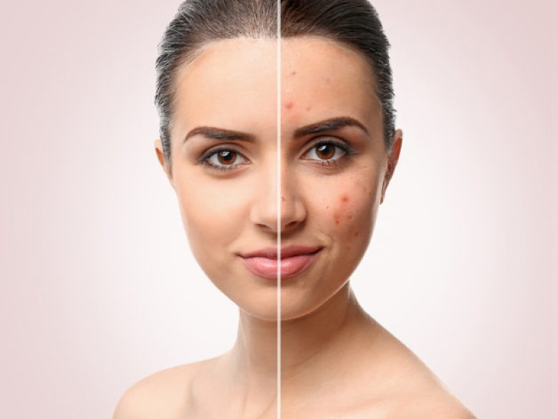 Aknebehandlung mit IPL bei Estetica Javea: Gesunde und strahlende Haut wiedererlangen