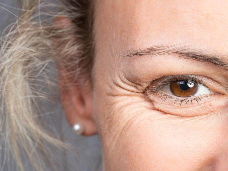 Botox in den Krähenfüßen in Javea: Eine präzise Behandlung für einen jugendlichen Blick