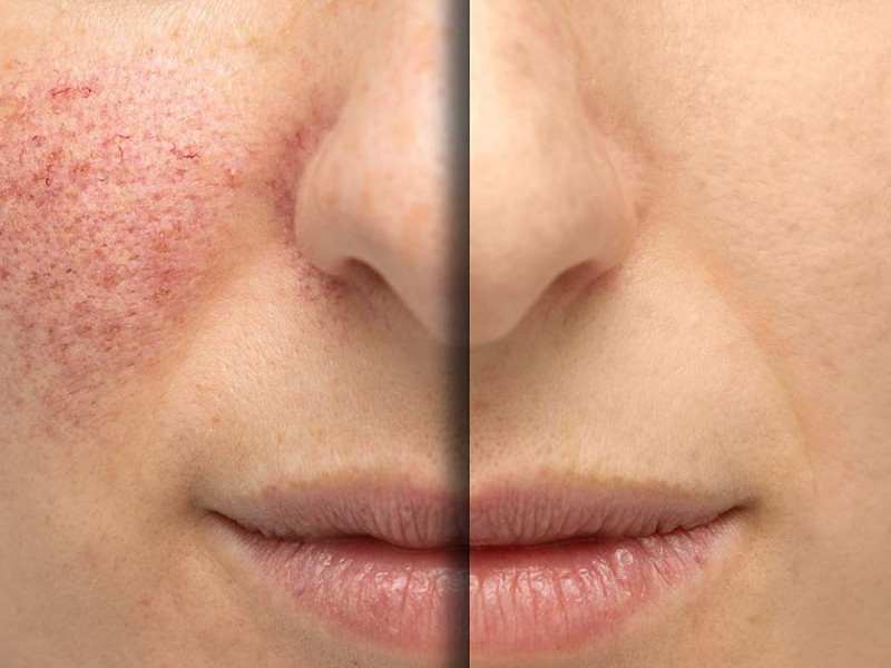 Entdecken Sie die IPL-Photorejuvenation für eine falten- und fleckenfreie Haut bei Dr. Caroline Carbasse in Estetica Javea