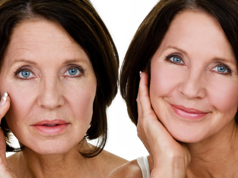 Gesichtsverjüngung in Javea mit Dr. Caroline Carbasse: Nicht-chirurgische Mini-Liftings