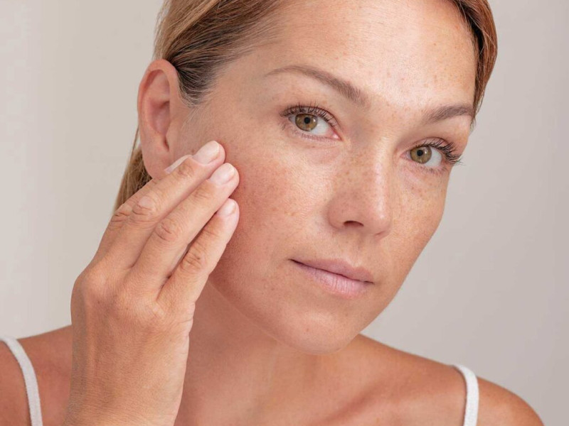 Sagen Sie Besenreisern und Hautunreinheiten Lebewohl mit der IPL-Behandlung bei Dr. Caroline Carbasse in Estetica Javea