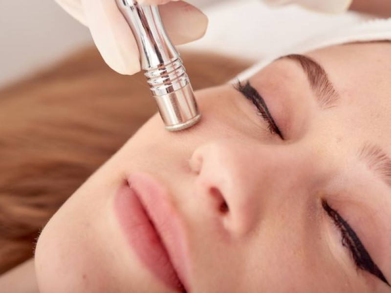 Entdecken Sie die Vorteile der Mikrodermabrasion bei Estetica Javea